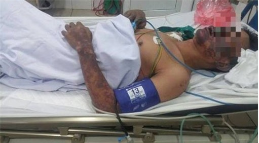 Bệnh nhân bị ban hoại tử chủ yếu ở mặt và các chi