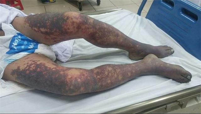 Các ban hoại tử tím đen toàn thân xuất hiện sau 5 ngày anh T. ăn tiết canh từ lợn cắp nách. Ảnh: N.C