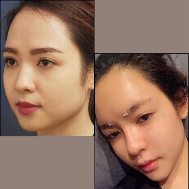 Cấy mỡ tự thân - Phương pháp làm đẹp 2 trong 1 đang hot nhất hiện nay - Ảnh 9.