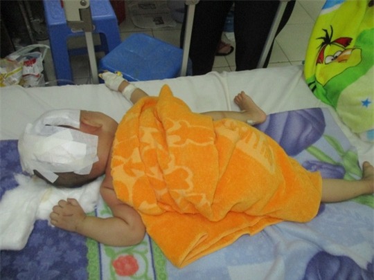 Bé Bảo bị chấn thương sọ não, hiện đang điều trị tại Bệnh viện Đa Khoa Trà Vinh