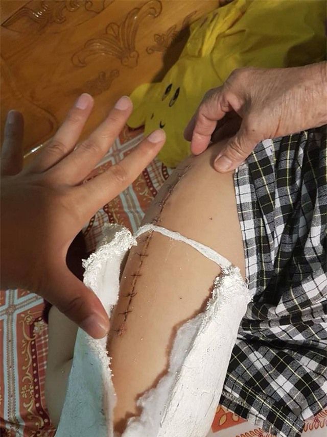Cháu Kiên bị bó bột sau khi ngã ở sân trường