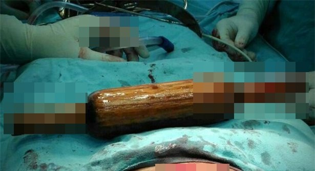 Chồng viện cớ say rượu nhét cả cái chày dài 40 cm vào trong cơ thể người vợ vô sinh - Ảnh 1.