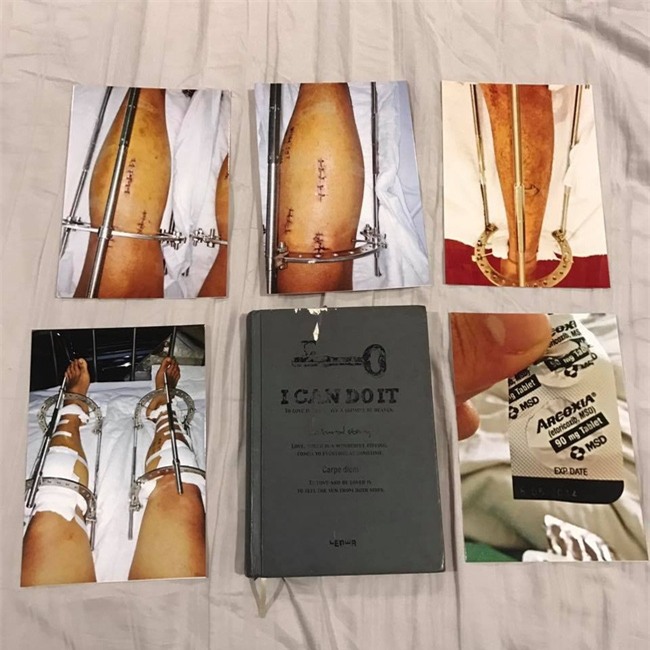 Nhật ký kéo dài chân từ 1m67 đến 1m76 (9 cm) của chàng trai Hà Nội - Ảnh 2.