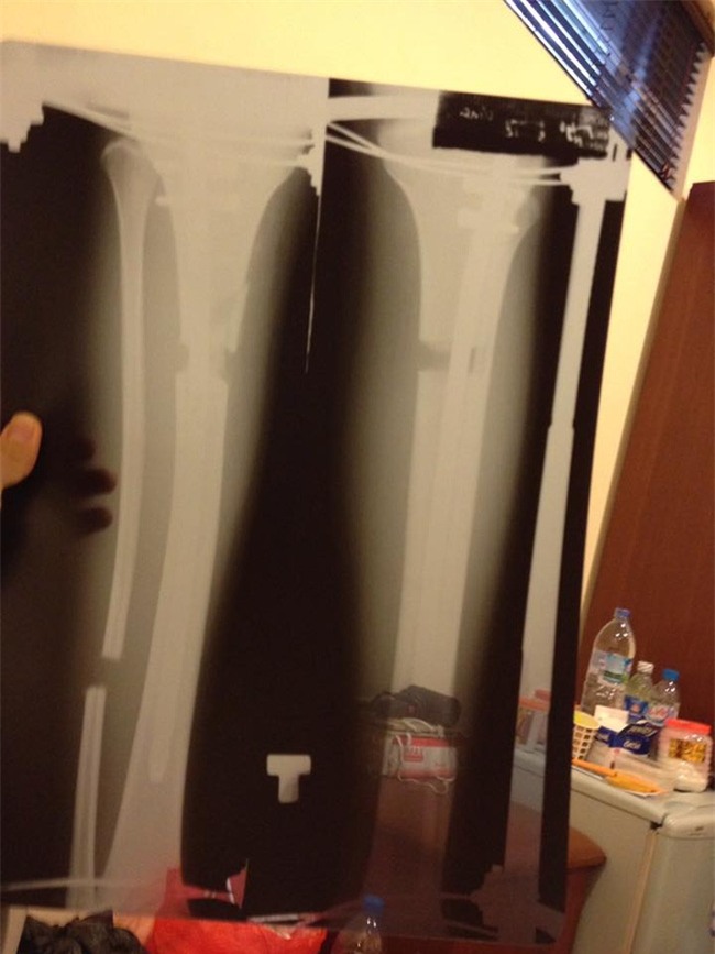 Nhật ký kéo dài chân từ 1m67 đến 1m76 (9 cm) của chàng trai Hà Nội - Ảnh 5.