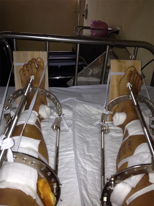 Nhật ký kéo dài chân từ 1m67 đến 1m76 (9 cm) của chàng trai Hà Nội - Ảnh 6.