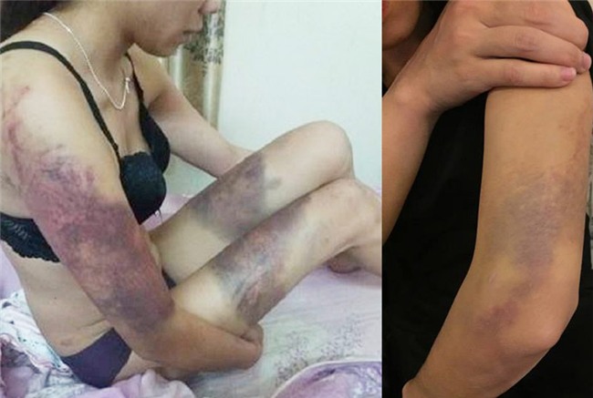 thanh nien khai ly do danh dap nguoi yeu bam tim co the - 1