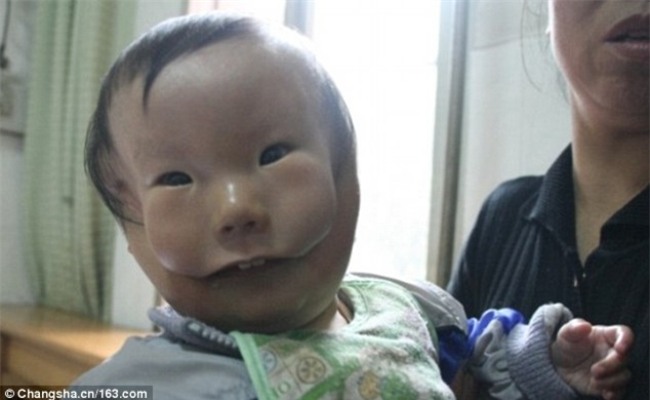 Cậu bé hai mặt lúc nào cũng như đang đeo mặt nạ từ lúc mới sinh - Ảnh 1.