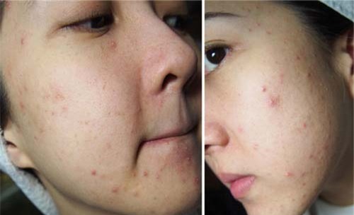 99% chi em mac phai 5 thoi quen nay khien mun moc nhu no hoa tren mat - 5