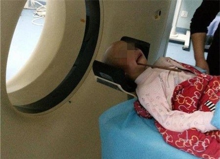 Nếu bạn vẫn còn nghĩ đũa ăn vô hại với trẻ nhỏ thì hãy xem những tai nạn kinh hoàng này - Ảnh 4.