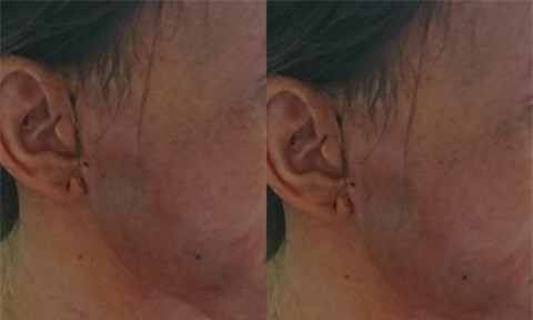 Bơm má xóa nếp nhăn để đón tết, người phụ nữ nhập viện vì bị tai biến - Ảnh 1.