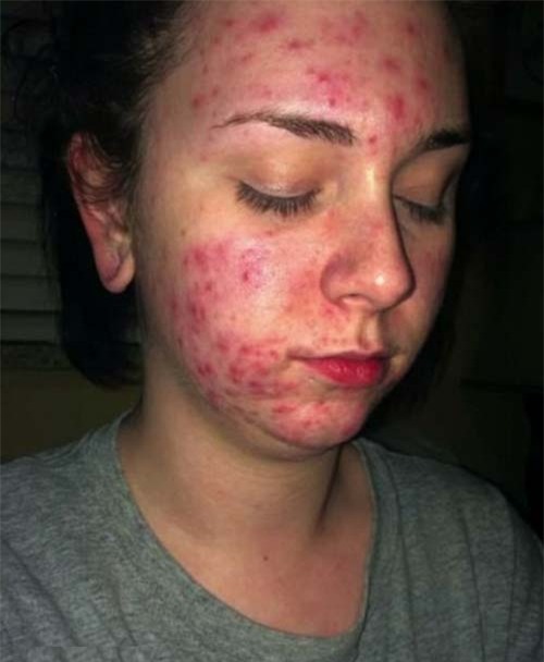 dung qua ton sung vaseline trong lam dep ma khong biet den nhung tac hai nay cua chung - 2