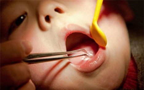 Be gai suyt mat mang vi co giao loi chiec thia hoc o co hong hinh anh 1