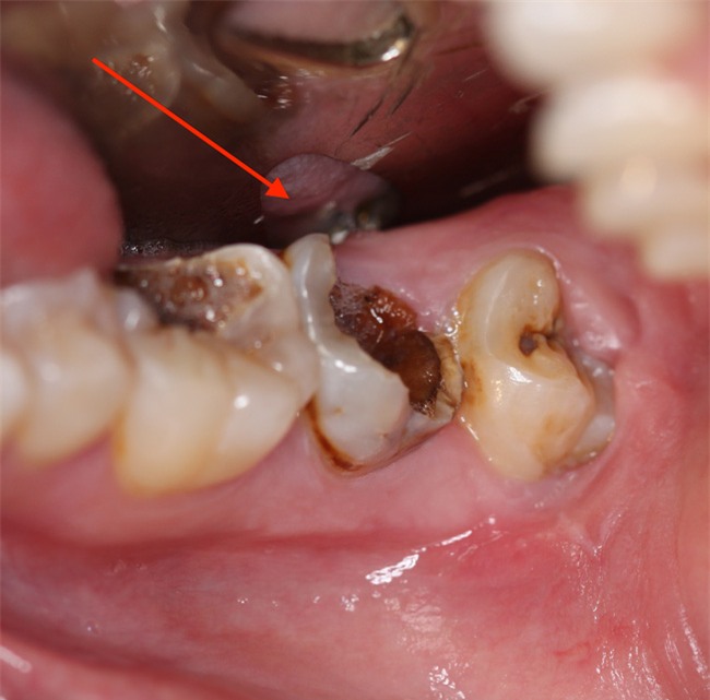 Những phương thuốc tự nhiên này sẽ giúp bạn chữa sâu răng hiệu quả ngay tại nhà - Ảnh 1.