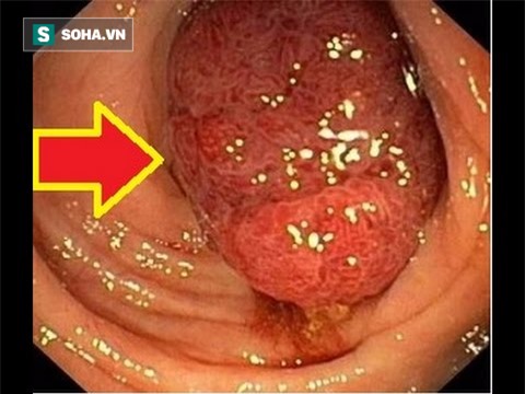 Ung thư vì bỏ qua triệu chứng suốt 10 năm: Bác sĩ chỉ rõ 3 dấu hiệu chớ coi thường - Ảnh 2.