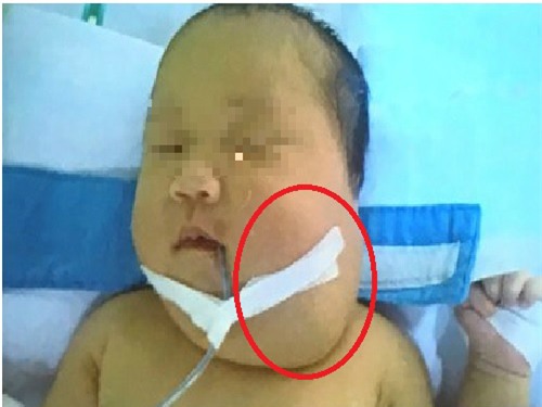 bé gái mang khói buóu quái hiém gạp, làn dàu tien ghi nhạn ỏ viẹt nam - 1