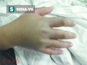 Mổ cá đón Tết, cắt cả bàn tay vì hoại tử: BS cảnh báo vi khuẩn chết người có trong hải sản - Ảnh 2.