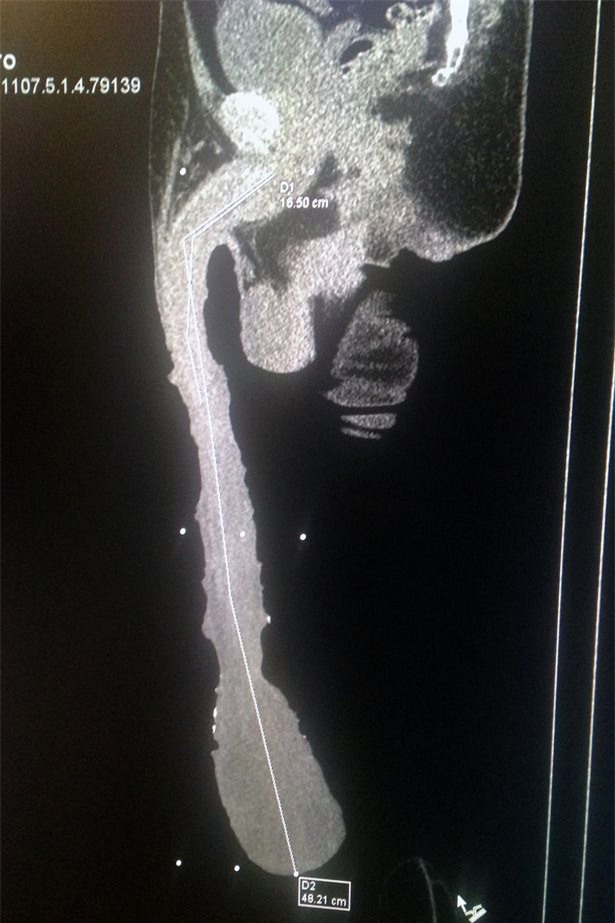 “Của quý” dài tới 48cm của ông Roberto khiến ông gặp nhiều khó khăn