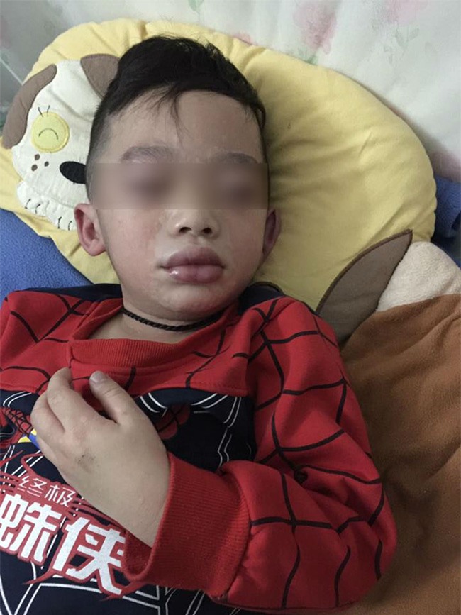 Mùng 3 Tết, bé trai nhập viện trong tình trạng mặt mũi sưng vù vì uống trà sữa? - Ảnh 3.