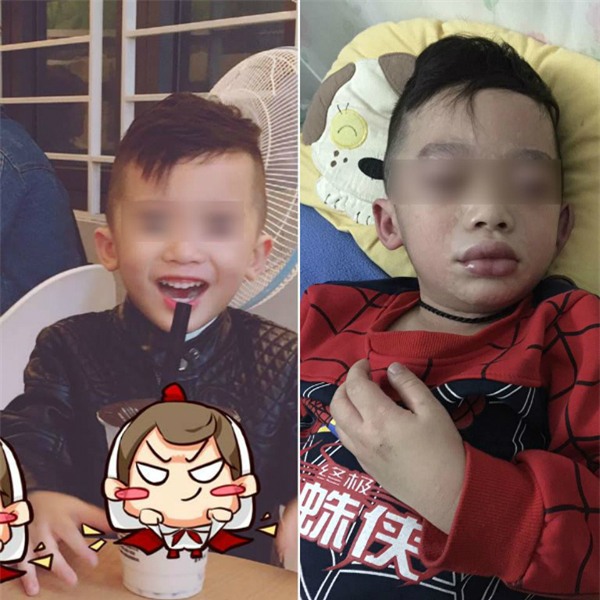 Mùng 3 Tết, bé trai nhập viện trong tình trạng mặt mũi sưng vù vì uống trà sữa? - Ảnh 5.