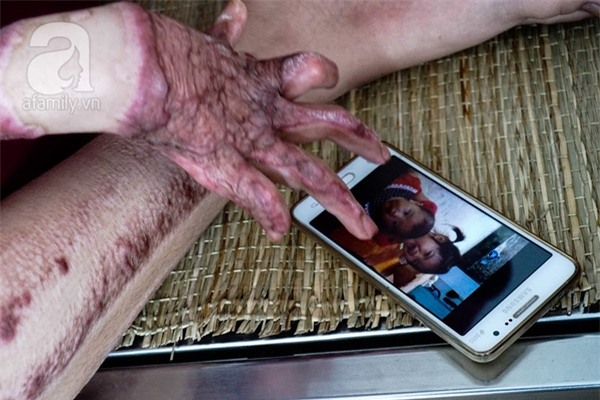 Cô gái bị chồng thiêu sống đúng mùng 2 Tết năm ngoái vẫn đang trên hành trình tìm lại hình hài - Ảnh 10.