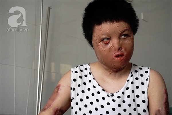Cô gái bị chồng thiêu sống đúng mùng 2 Tết năm ngoái vẫn đang trên hành trình tìm lại hình hài - Ảnh 2.