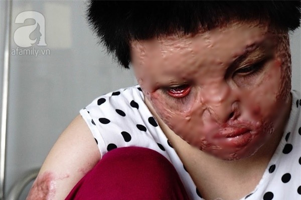 Cô gái bị chồng thiêu sống đúng mùng 2 Tết năm ngoái vẫn đang trên hành trình tìm lại hình hài - Ảnh 3.