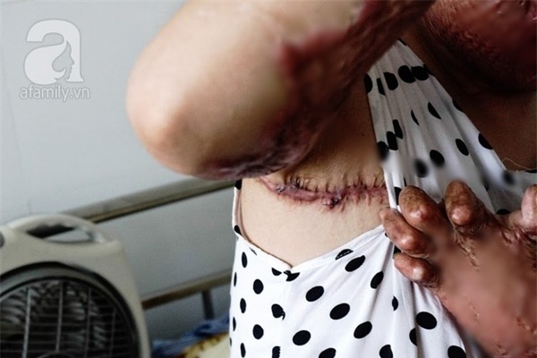 Cô gái bị chồng thiêu sống đúng mùng 2 Tết năm ngoái vẫn đang trên hành trình tìm lại hình hài - Ảnh 4.