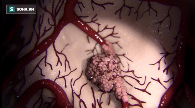 7 loại bệnh ung thư nếu phát hiện sớm cơ hội chữa khỏi từ 90 - 100% - Ảnh 1.