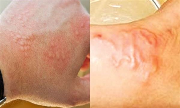 cach-phat-hien-giun-san3