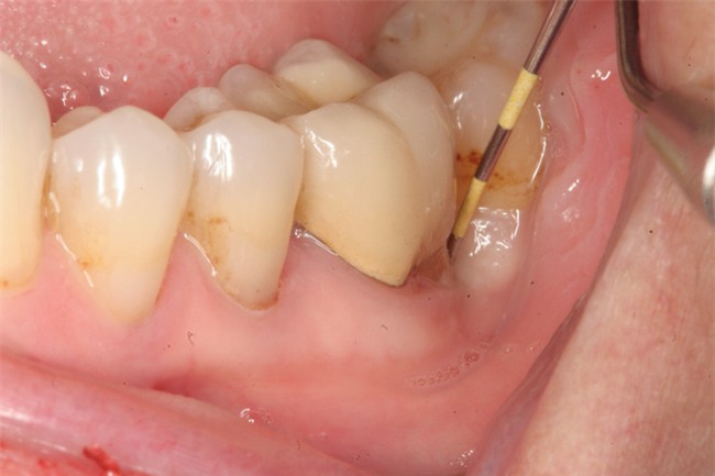 Ông bố 26 tuổi tử vong vì một chiếc răng sâu: Nhiều người lo lắng vì từng phạm sai lầm này - Ảnh 3.