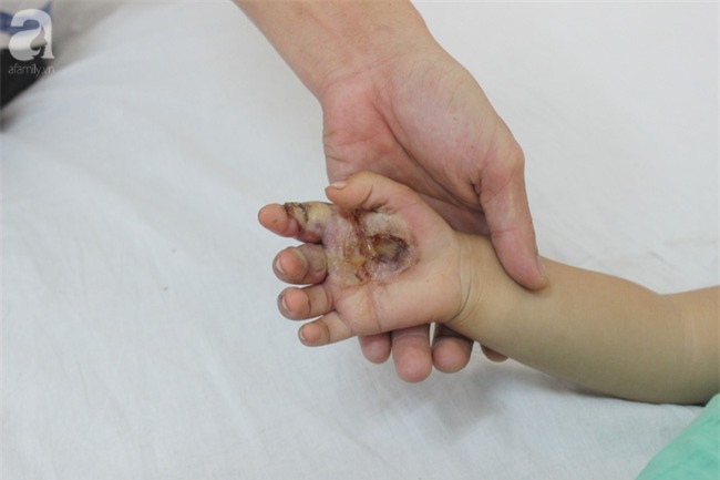 Nghịch bóng đèn bàn thờ ông Địa, bé trai 23 tháng tuổi bị bỏng nặng bàn tay - Ảnh 1.