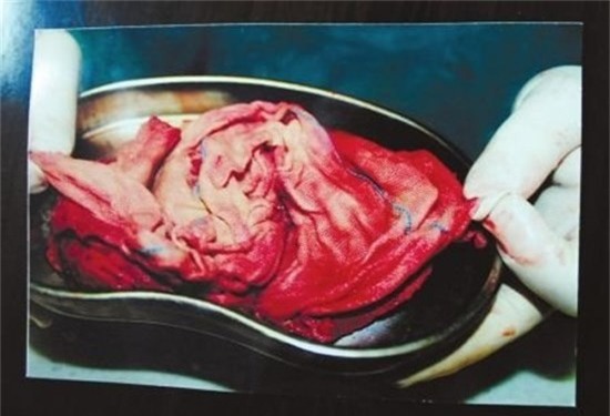 Sản phụ bị bác sĩ bỏ quên băng gạc trong người hơn 70 ngày, bệnh viện đền 100.000 đồng - Ảnh 4.