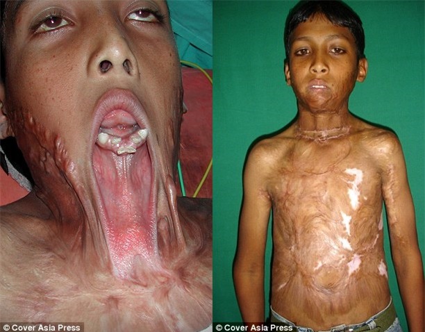 Chàng trai từng tuyệt vọng vì bị mồm dính ngực sau hỏa hoạn năm nào giờ đã có cuộc sống mới đầy hạnh phúc - Ảnh 1.