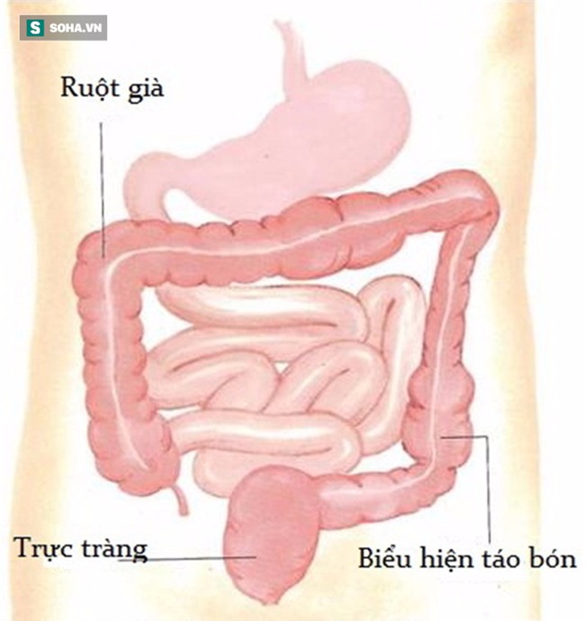 Đừng để bị táo bón lâu ngày vì đây chính là con đường dẫn đến ung thư và suy thận - Ảnh 1.