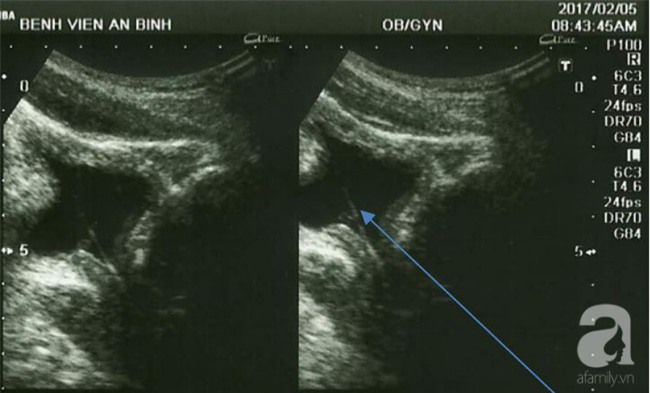 Tự khều sỏi thận, người đàn ông bị vướng cỏ trong… “chỗ hiểm” - Ảnh 1.