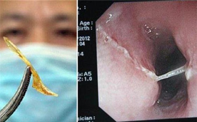 Hóc xương cá, áp dụng thói quen vẫn làm, ông cụ 70 tuổi nôn ra 2l máu