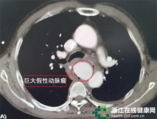Hóc xương cá, áp dụng thói quen vẫn làm, ông cụ 70 tuổi nôn ra 2l máu - Ảnh 2.