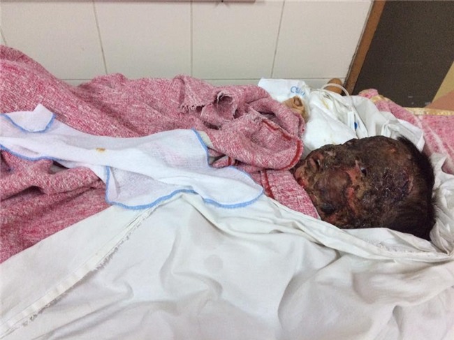 Bé trai cháy đùng đùng như ngọn đuốc sống cầu xin cứu giúp