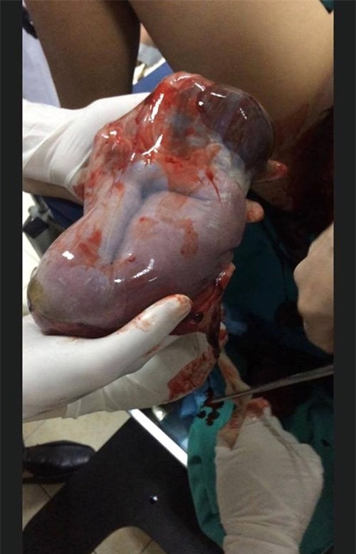 hy huu: san phu sinh be gai 800 gram con nguyen trong boc nuoc oi - 2