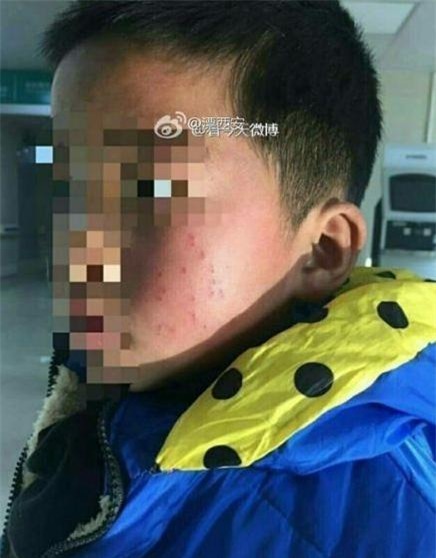 Hiệu trưởng trường tiểu học dùng bút bi đâm 17 nhát vào mặt học sinh - Ảnh 1.