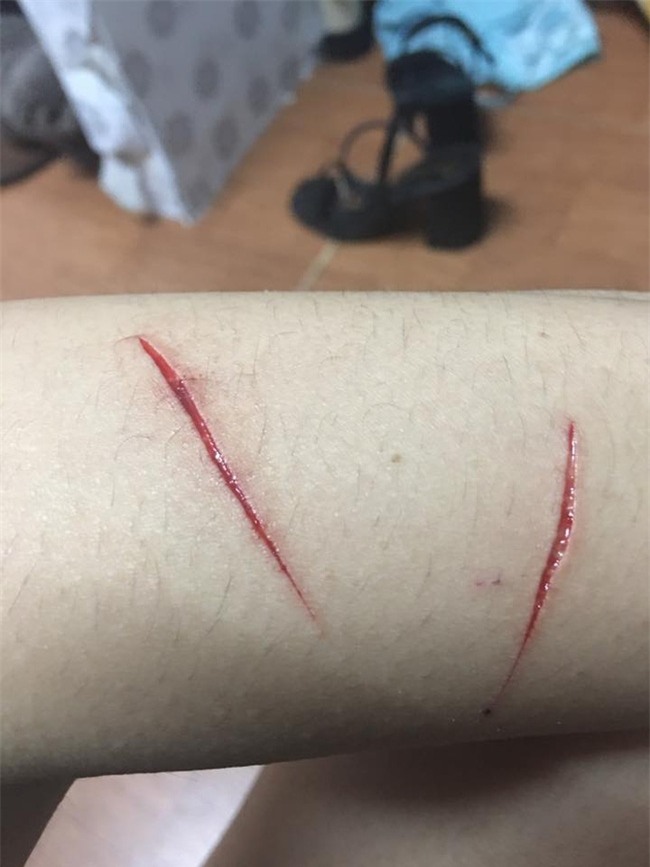 Thêm 1 cô gái trẻ ở Sài Gòn chia sẻ câu chuyện bị nhóm biến thái rạch đùi trong đêm - Ảnh 2.