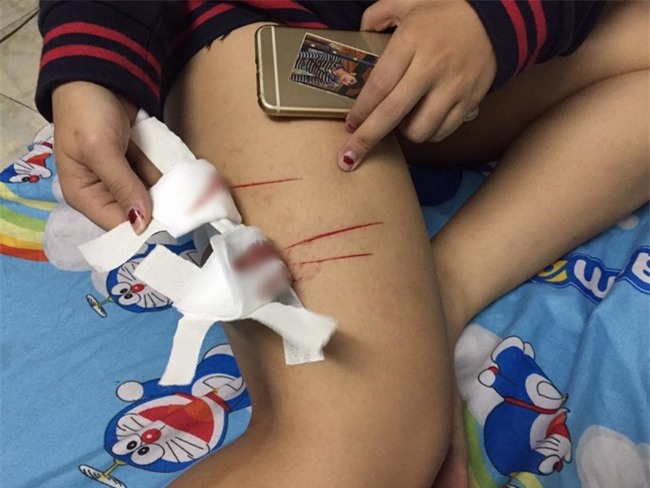 Thêm 1 cô gái trẻ ở Sài Gòn chia sẻ câu chuyện bị nhóm biến thái rạch đùi trong đêm - Ảnh 5.