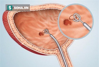 Bác sĩ Bệnh viện Đại học Y hướng dẫn bài tập khi đi tiểu giúp phòng ung thư bàng quang - Ảnh 2.