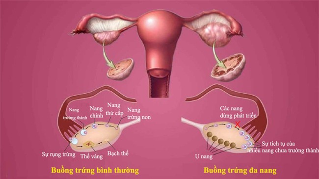 Căn bệnh dẫn đến tiểu đường, bệnh tim: Tránh xa 8 loại thực phẩm nếu bạn không muốn mắc - Ảnh 1.