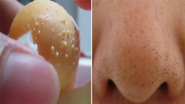 Lăn mặt bằng trứng gà luộc: chưa kịp sạch mụn đã bị viêm da - Ảnh 1.