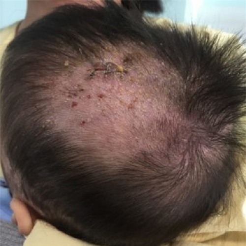 be trai 27 thang tuong bi benh da lieu don gian, khong ngo mac benh hiem gap - 1