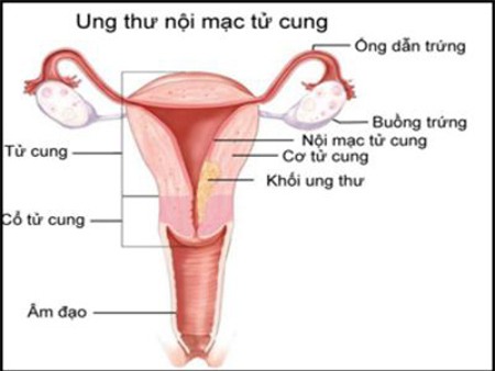 5 dau hieu ung thu noi mac tu cung ai cung nen biet - 1