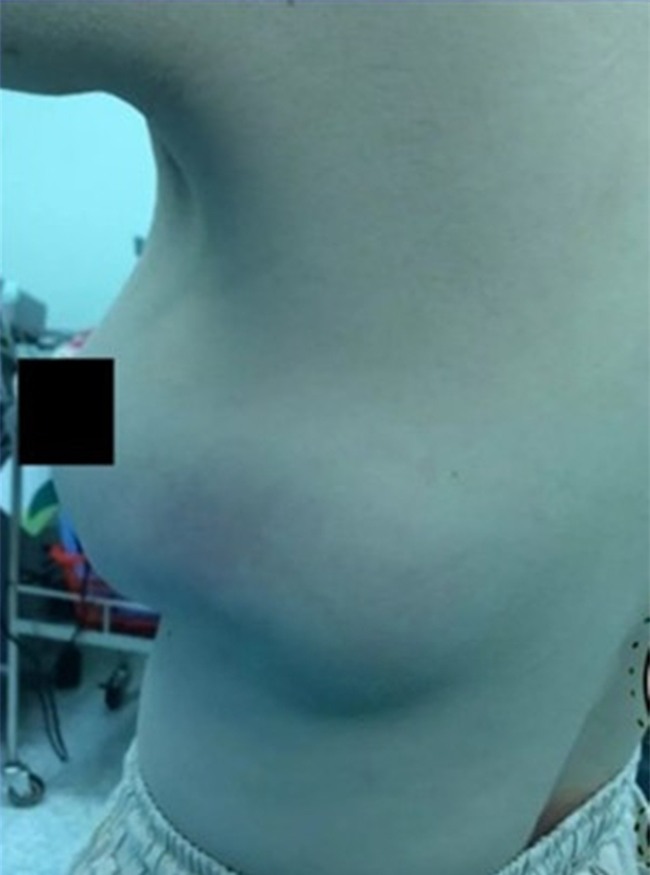 Sau 10 năm thẩm mỹ, người phụ nữ cay đắng gỡ miếng độn ngực đang dần trôi về sau lưng - Ảnh 1.