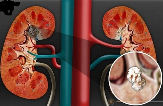 Ly sinh tố dễ làm, dễ kiếm có khả năng đánh bay sỏi thận mà bạn không hay biết - Ảnh 1.