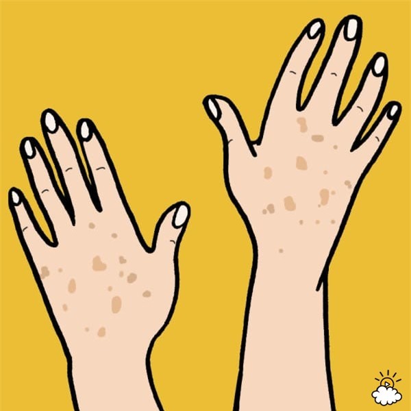 5 dấu hiệu da bị tổn thương do ánh mặt trời gây ra bạn không nên bỏ qua - Ảnh 1.
